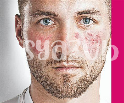 Viagra Und Rosacea: Gibt Es Eine Verbindung?